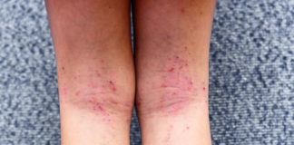 The dermatology of addiction effects of drugs on skin