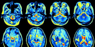Functional MRI used to investigate new drugs for drug relapse prevention