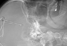 Brain Implant to Combat Addiction? First ever U.S. trial of a “pacemaker for the brain” for treatment resistant opioid use disorder