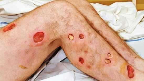Effects of Krokodil