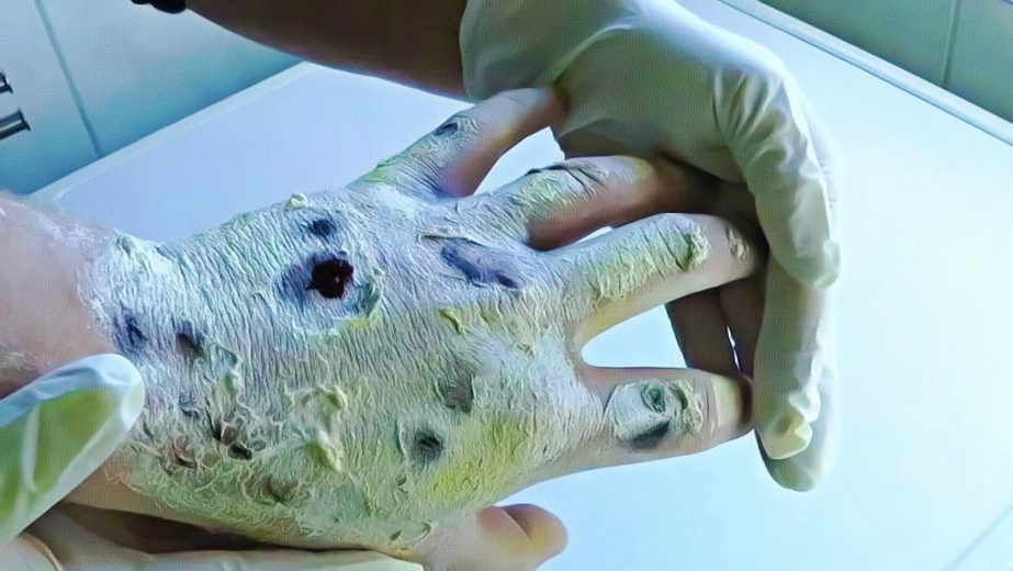 Krokodil Drug Effects on Hand