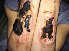 Krokodil Skin, Effects Causes and Treatments - Pictures