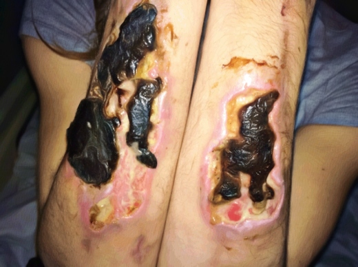 Krokodil Skin Effect on Forearm