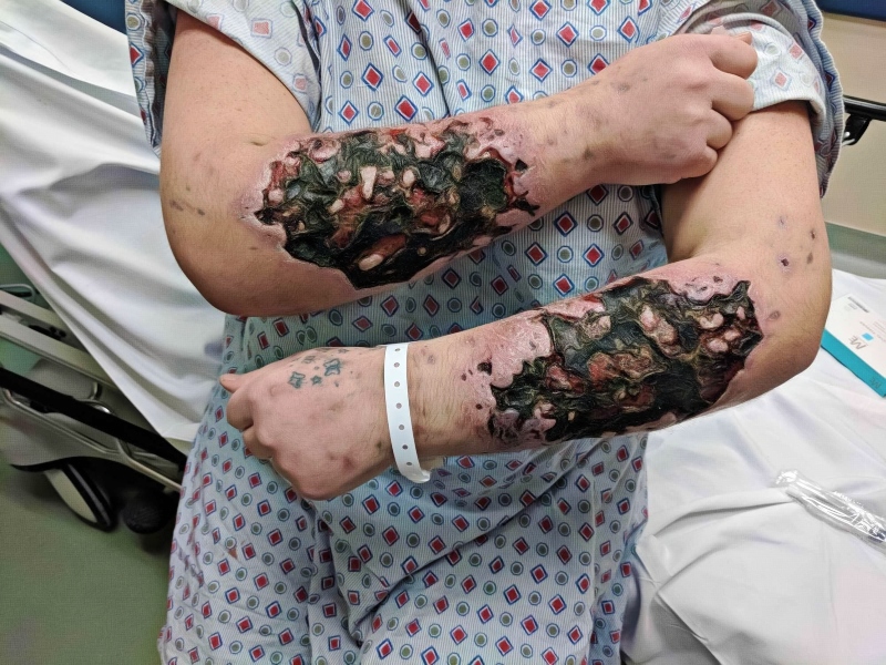 Krokodil Skin, Effects Causes and Treatments - Pictures
