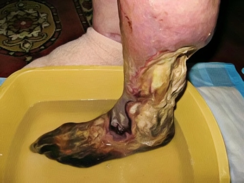 Krokodil Skin on Leg and Ankle