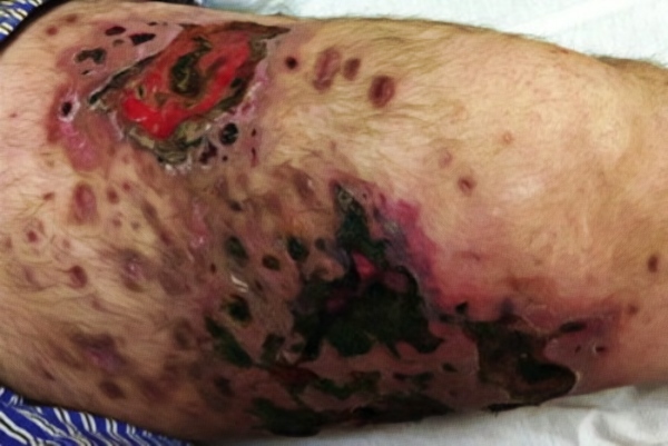 Krokodil Effects on Skin-Thigh