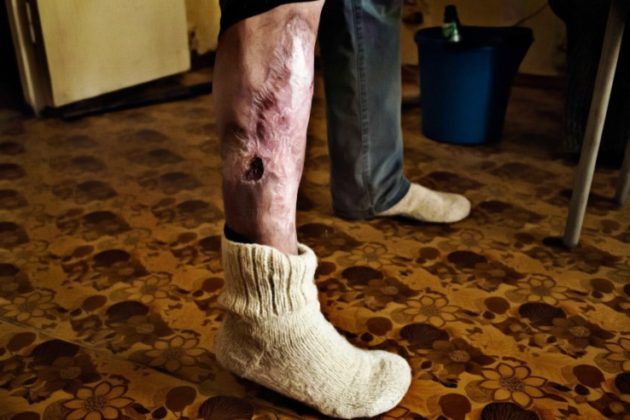 Krokodil Skin, Effects Causes and Treatments - Pictures