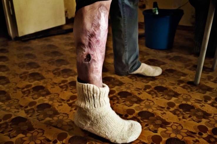 Krokodil Skin on User's Leg