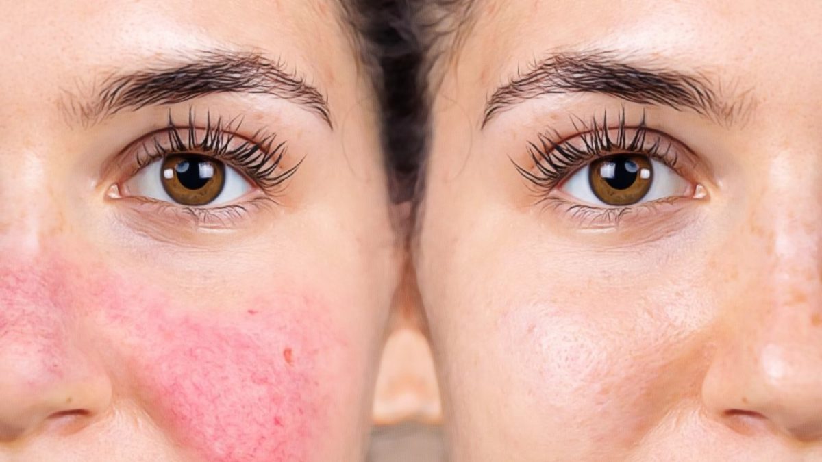 Does Alcohol Cause Spider Veins On Nose