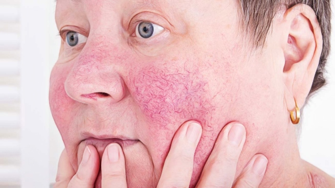 Rosacea and Alcohol