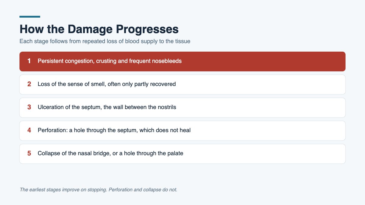 Five stage warning diagram showing how cocaine related nasal damage progresses from congestion to septal perforation.
